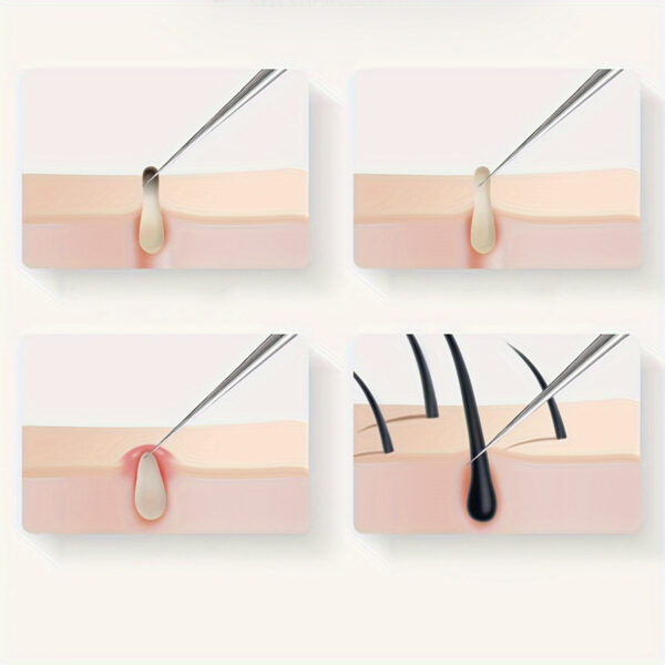 Stainless Steel Blackhead & Blemish Remover Set - Unscented Acne Extraction Tools for Face & Nose, Normal Skin Type - Professional Facial Care Kit for Whiteheads & Pimples - Image 10